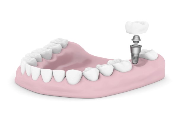 Smile Again With Dental Implants
